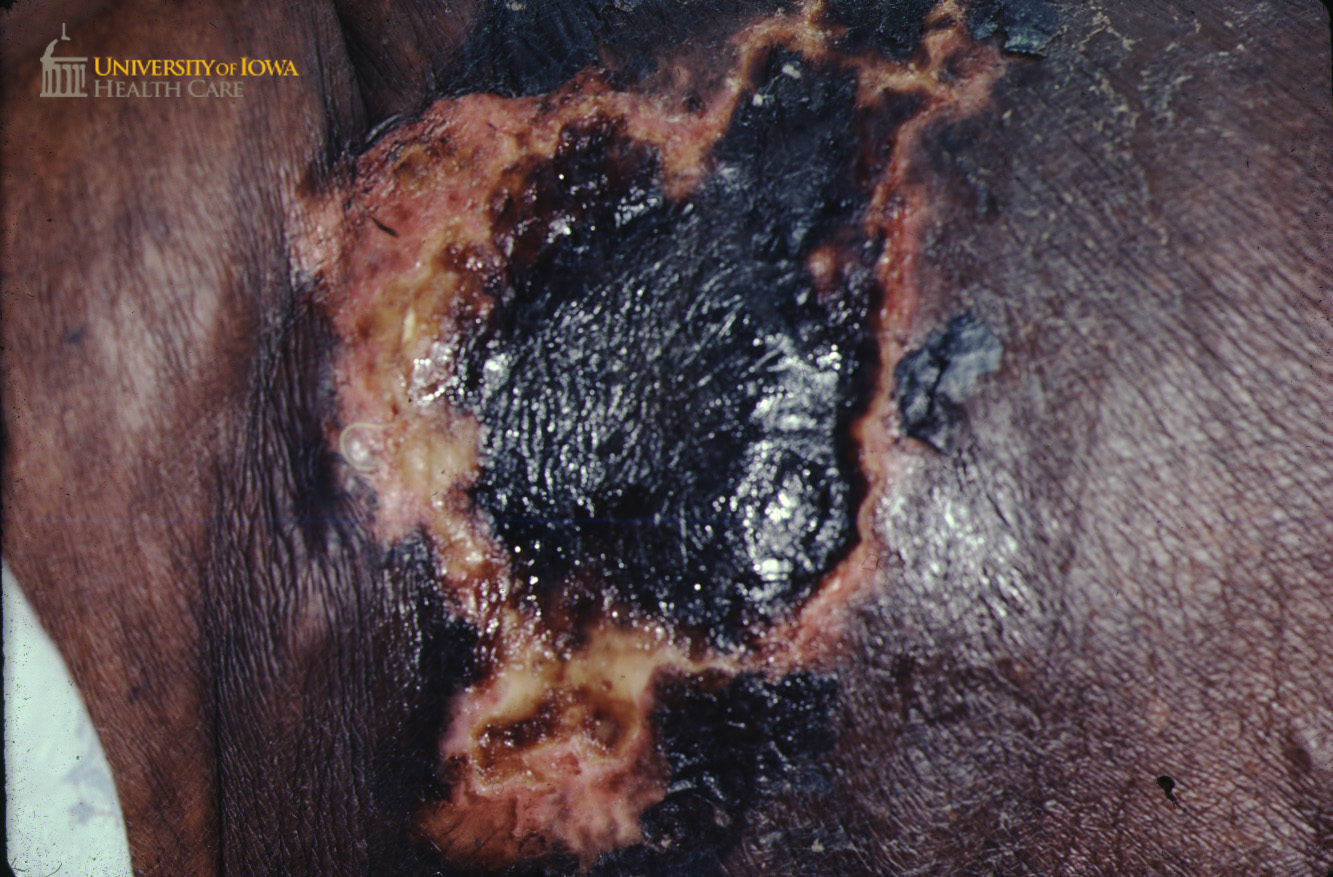 Necrotic ulcer wiith surrounding hyperpigmented patch and papules on the axillae. (click images for higher resolution).